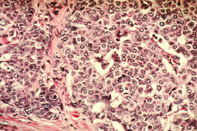 Células cancerígenas. Wikimedia Commons